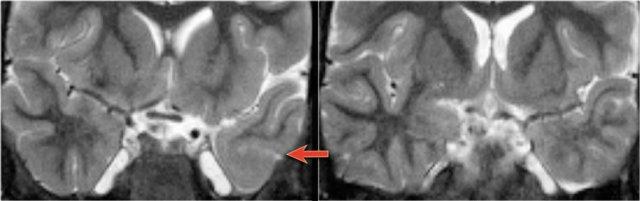 Focal cortical dysplasia. Coronal T2WI